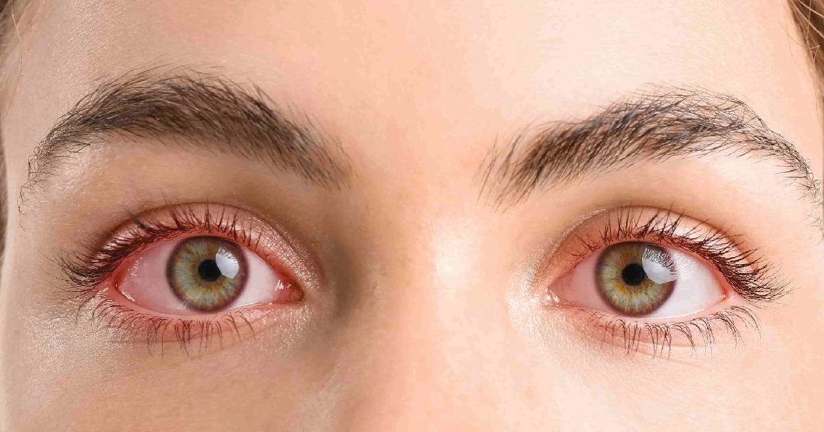 Close-up of a person’s face in Chicago, IL, showing red, bloodshot eyes with green-brown irises, well-defined eyebrows, and long eyelashes, indicative of Dry Eye Disease.