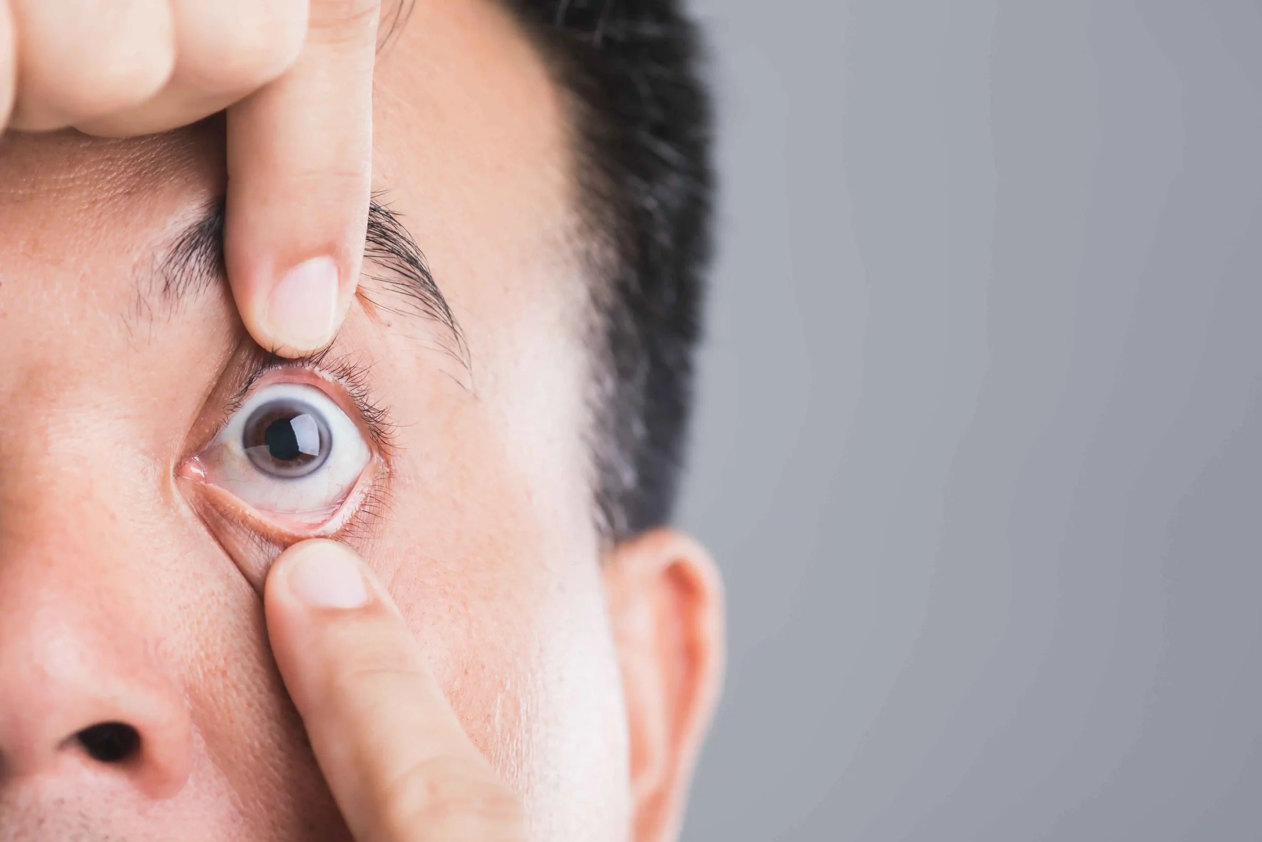 Macular Degeneration